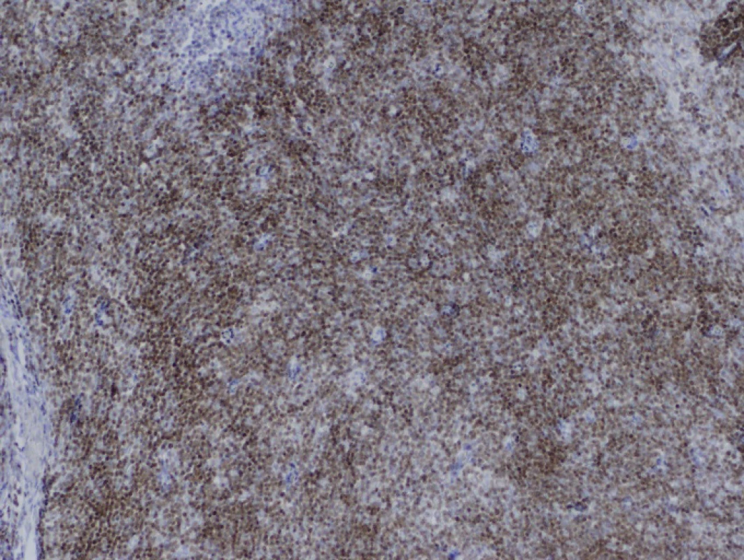 Iimunohistochemické vyšetření TdT, zvětšení 100krát