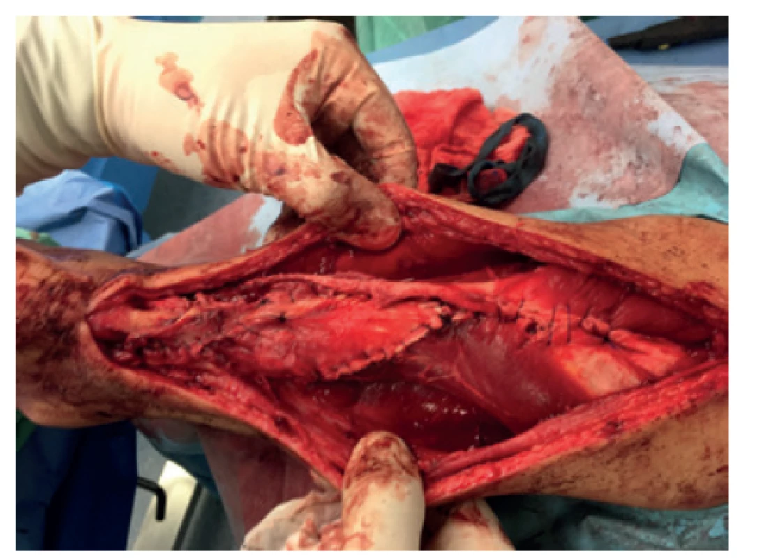 Dokončení plastiky dle Abrahama-Pankoviche<br>
Fig. 4: Completion of plasty using the Abraham-Pankovich
technique