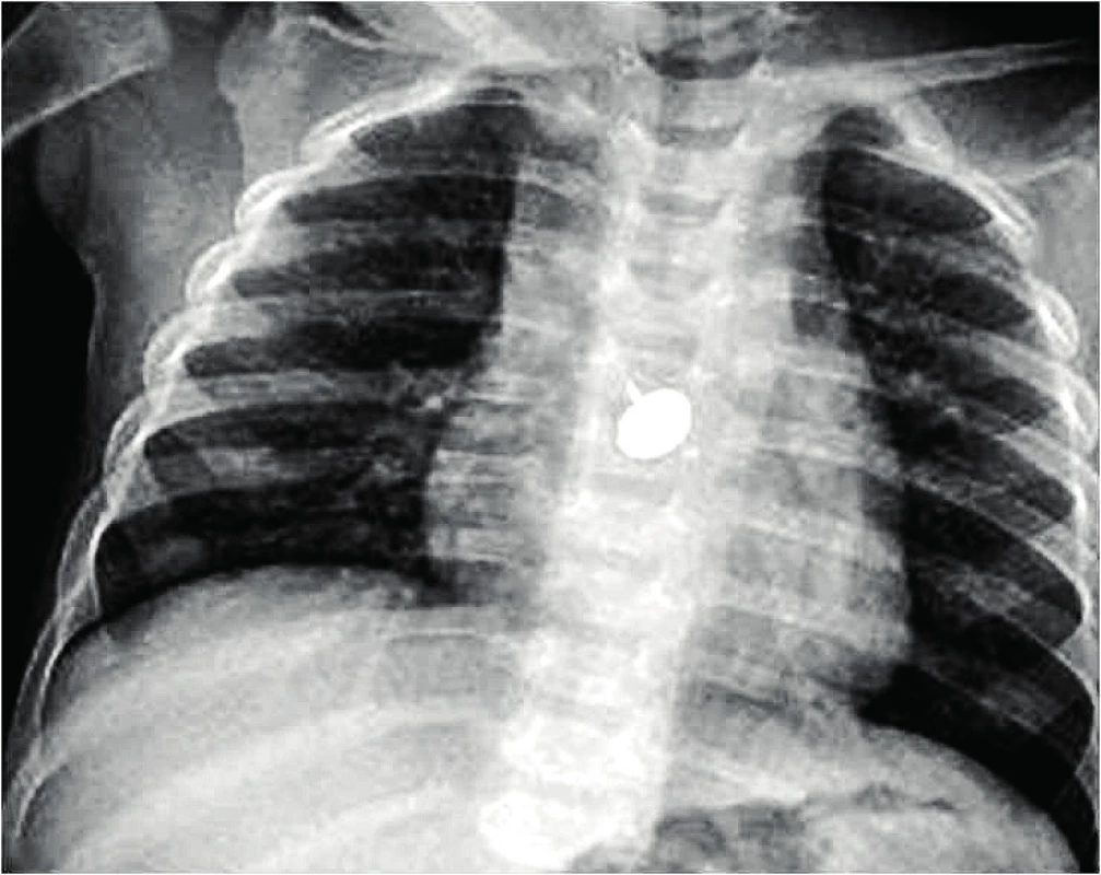 Připínáček v jícnu.<br><b> Fig. 5.</b> Tack in the esophagus.
