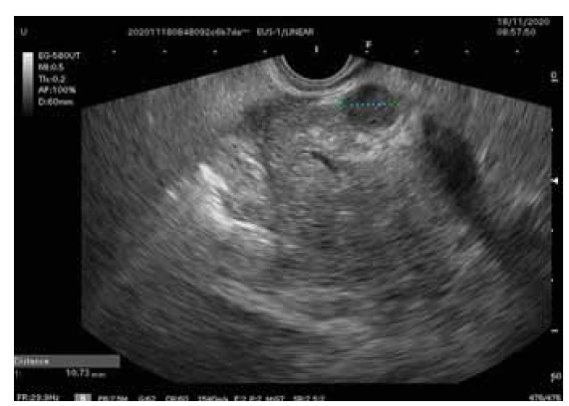 Endosonografický nález zväčšenej hlavy pankreasu
a peripankreatickej lymfadenopatie.<br>
Fig. 2. Endosonographic finding of enlarged pancreatic head
and peripancreatic lymphadenopathy.