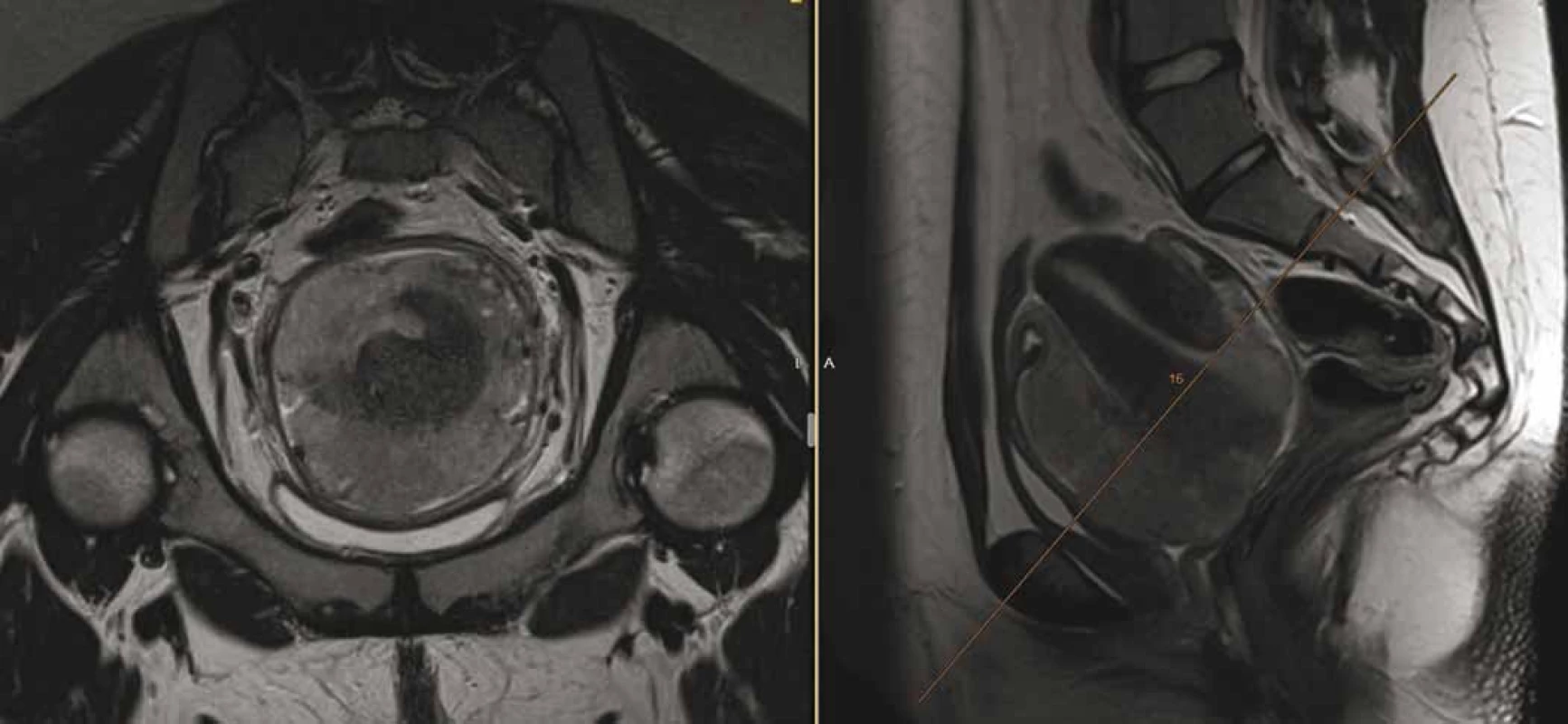 Magnetická rezonance pánve odhalující tumor velikosti 80 × 90 × 80 mm, vycházející z oblasti děložního hrdla, de facto
obdávající dělohu, vyplňující pochvu, naléhající na močový měchýř a rektum (bez zřetelné invaze), lymfadenopatie presakrálně
(30 × 15 × 15 mm) a bilaterálně parailicky (28 × 21 × 40 mm).