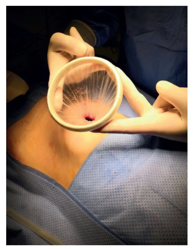 Vertikální incize v pupku se zavedeným Alexis retraktorem<br>
Fig. 1: Vertical incision in the umbilicus with the Alexis
retractor