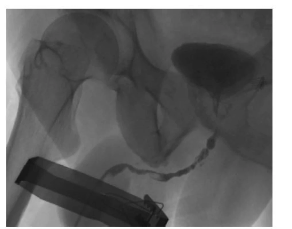 Muž 71 let, po laparoskopické nervy šetřící
radikální prostatektomii pro adenokarcinom pT2a
cN0M0 R0 GS 7 (4+3) v 10/2015, brzy poté byla provedena
pravidelná dilatace uretry (obvykle pouze 12 F) s následnou
epicystostomií. Na uretrografii byla zjištěna
panstriktura penisní a bulbární uretry a v 8/2020 byla
provedena uretroplastika a meatoplastika (délka striktury
14 cm). Následně uretrální píštěl v penoskrotálním
úhlu, přechodně epicystostomie, píštěl zhojená s uretrální
strikturou (Jordan B), která byla řešena v 12/2020
incizí Ho/Yag laserem. Již 1/2021 rigidní stenóza v místě
řezu, řešená pravidelnou autodilací 16 F.<br>
Fig. 2. Man 71 years old, after laparoscopic nerve-
-sparing radical prostatectomy for adenocarcinoma
pT2a cN0M0 R0 GS 7 (4+3) in 10/2015, early after that
regular urethral dilatation was performed (usually
only 12 F) followed by epicystostomy. Panstricture of
penile and bulbar urethra was detected on urethrography
and in 8/2020 urethroplasty and meatoplasty
was provided (strictura lenght 14 cm). Subsequently,
urethral fisstula in the penoscrotal angle, temporarily
epicystostomy, fistula healed with urethral stricture
(Jordan B), which was solved in 12/2020 by incision
Ho/Yag laser. As early as 1/2021, rigid stenosis at the
incision site, solved by regular autodilation 16 F.