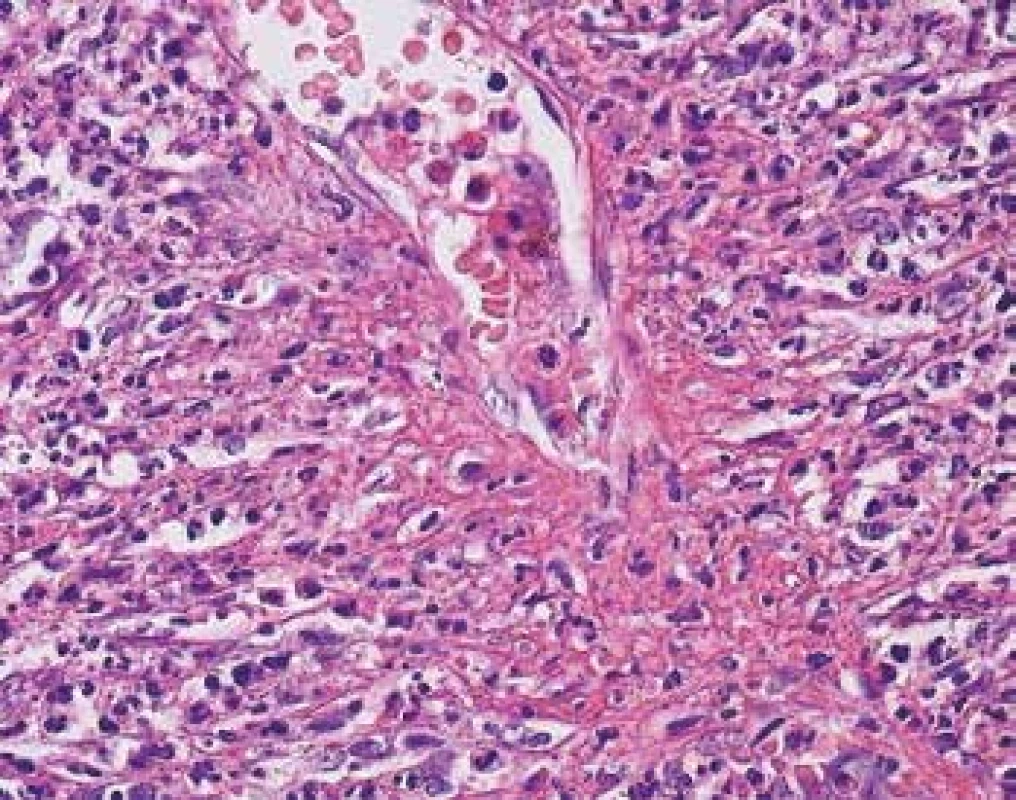 Detail vaskulitidy v biopsii kůže s průsakem fibrinu vytvářející typickou paprsčitou síťovitou strukturu v místě postižení tenkostěnné cévy. V okolí jsou četné polynukleáry (barvení HE s elastikou).