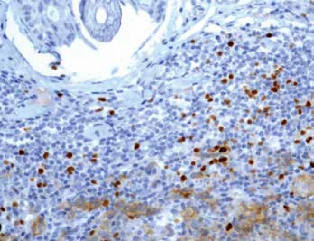 Imunohistochemický průkaz protilátky anti-FOXP3 u T regulačních
lymfocytů na periferii tumoru (zvětšení 200x).