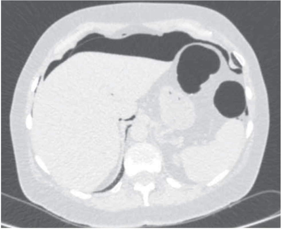 Na axiálním CT řezu v plicním okně patrná masivní
kolekce volného plynu (pneumoperitonea) praehepaticky. <br>
Fig. 1. In axial plane using lung window settings CT image
showing massive collection of free intraabdominal air (pneumoperitoneum)
in prehepatic space.
