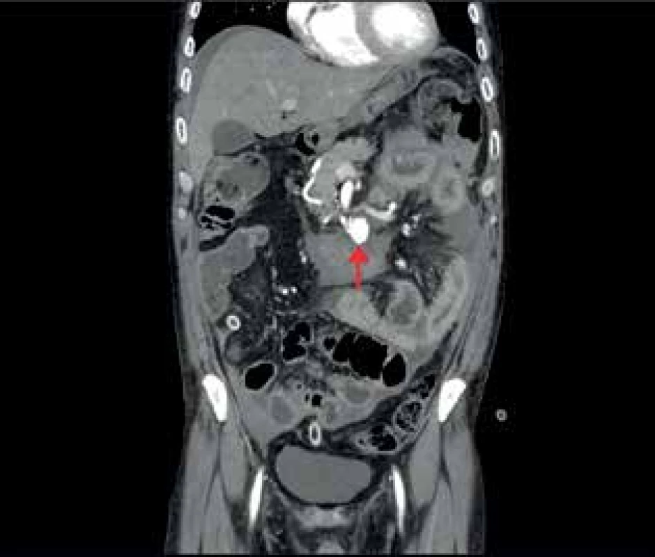 CT břicha s kontrastem
Patrné aneuryzma PDA (označeno šipkou) s  rupturou a  hemoperitoneem<br>
Fig. 1: CT of the abdomen with contrast
Visible is the PDA aneurysm (indicated by the arrow) with the 
rupture and haemoperitoneum