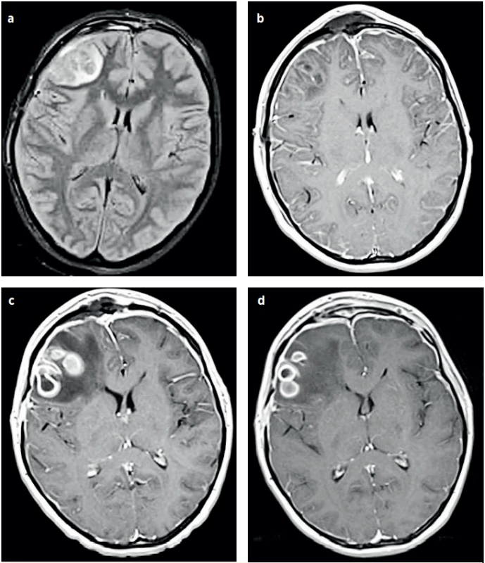 a–d (P1). NMR vyšetření hlavy, vývoj mozkového abscesu. 2. hospitalizační den (a), 4. hospitalizační den (b), 19. hospitalizační den (c), 23. hospitalizační den (d). (Za laskavého přispění MUDr. Pavla Rejtara)<br>
Fig. 4a–d (P1). Brain MRI, the development of the brain abscess. Day 2 of hospitalisation (a), Day 4 of hospitalisation (b), Day 19
of hospitalisation (c), Day 23 of hospitalisation (d). (Credit Dr. Pavel Rejtar)