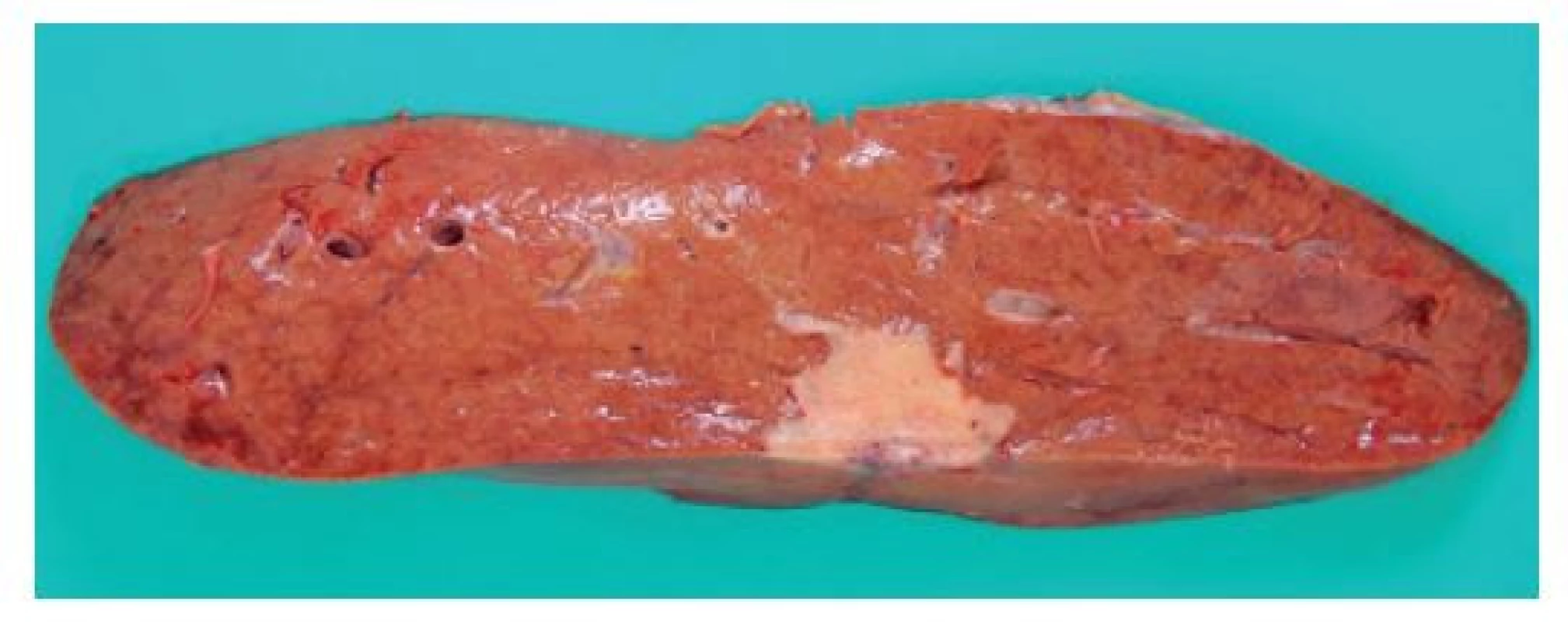 Pitevní makrofotografie zobrazující bělavý tuhý
cípatý nádor uložený v periferii jater pod viscerálním peritoneem<br>
Fig. 1: Autopsy photograph showing a whitish, firm serrated
tumor found in the liver periphery, beneath the visceral
peritoneum