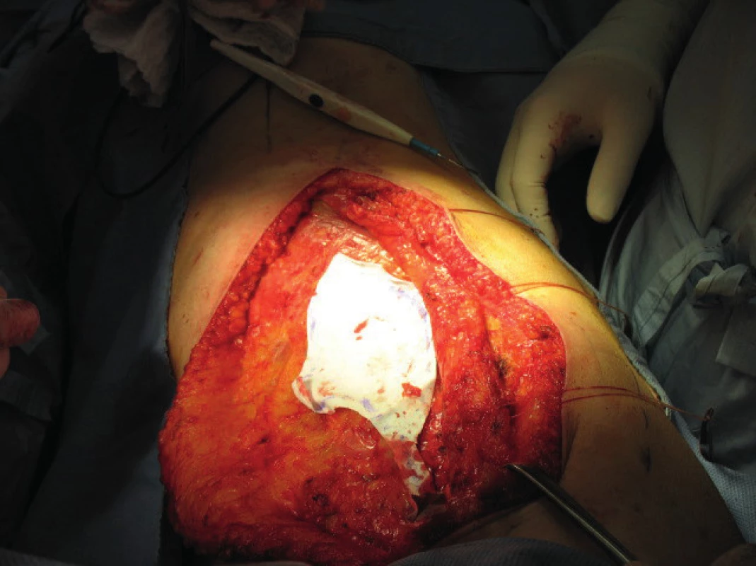 Marking the size of the serratus anterior muscle