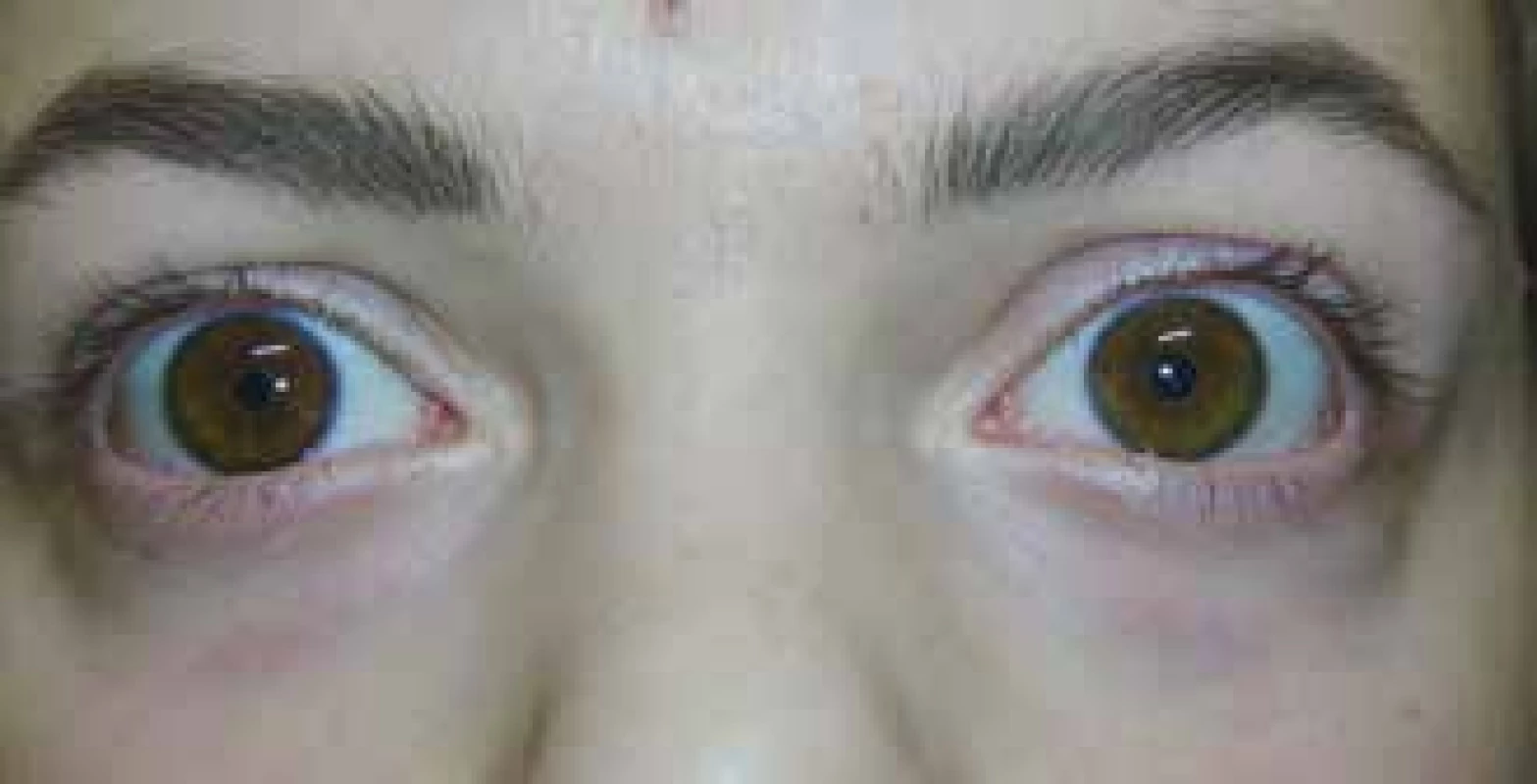 Positive result of pharmacological test with application
of 1.0% Pilocarpine in left eye
