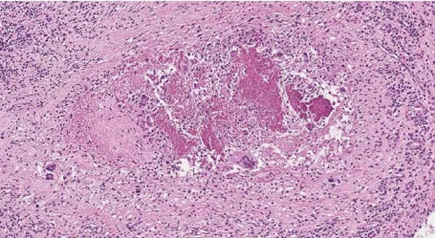 . Rheumatoid nodule – fibrinoid necrosis with palisading histiocytes, giant cells and lymphocytic inflammation. HE, 116x magnification.
