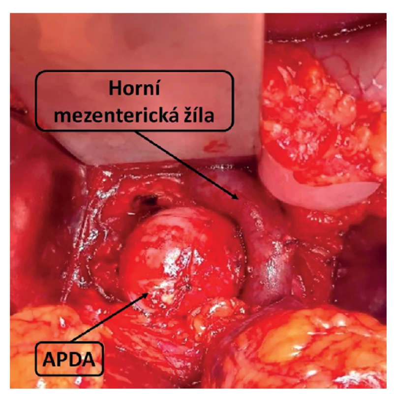 Peroperační nález APDA<br>
Fig. 3: Intraoperative finding of APDA