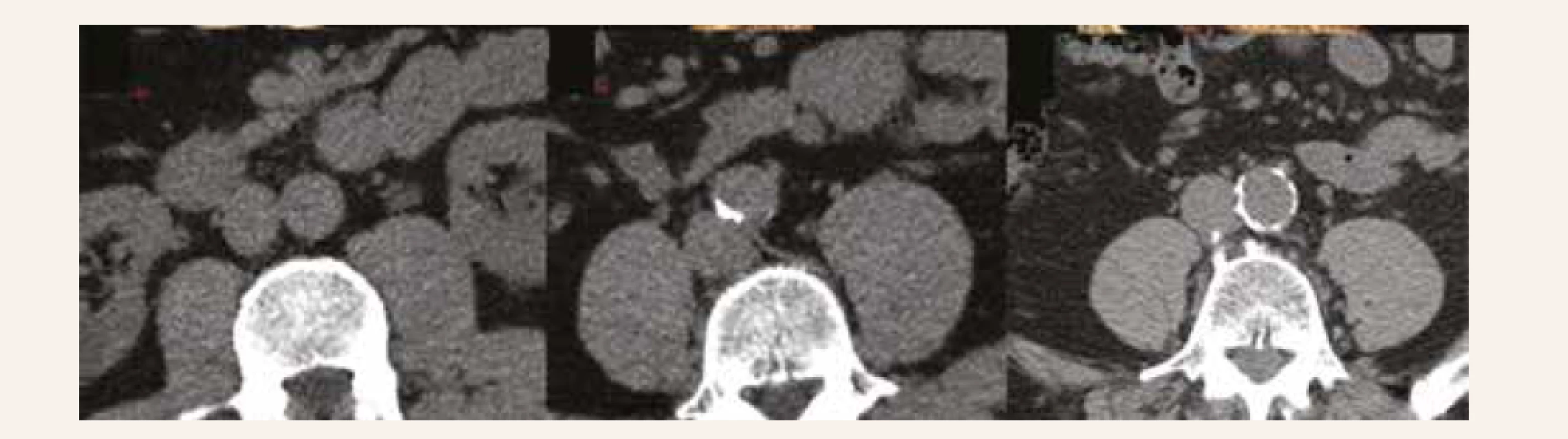 Axial slices presenting abdominal QCT scans: no abdominal aortic calcification (left panel),
mild calcification limited to right posterior quandrant (middle panel), and severe calcification nearly
on the entire circumference (right panel). Reproduced with senior author´s permission [26]