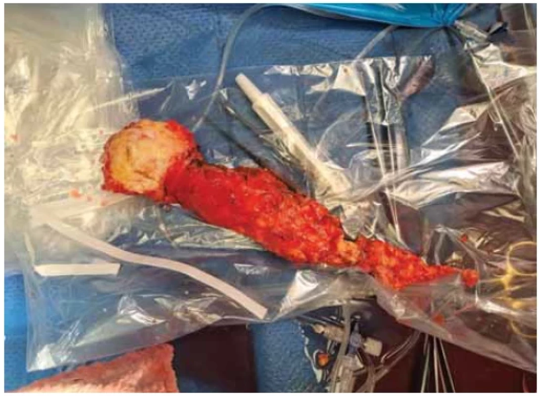 Resekát pankreasu na „back-table“. <br> 
Fig. 1. The resected pancreas on the “back-table”.