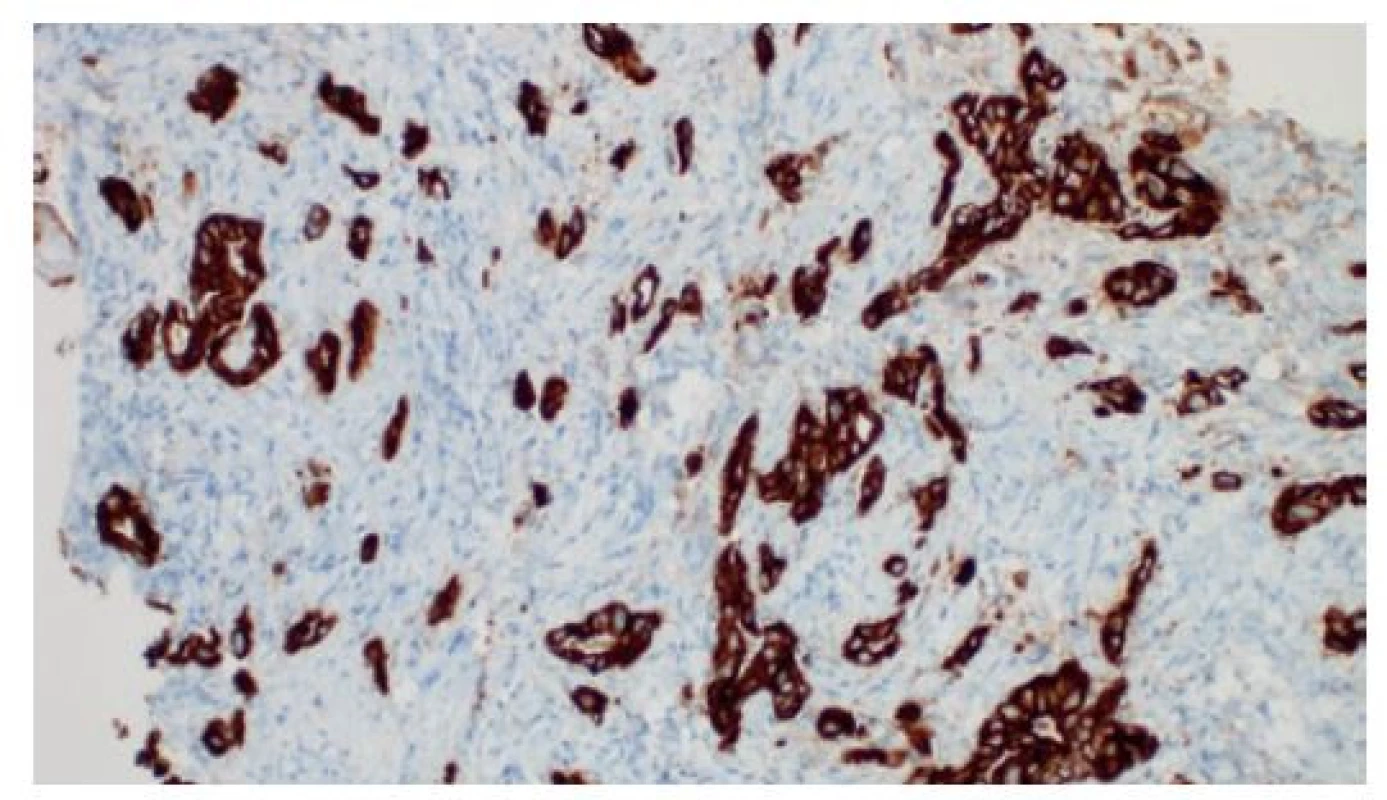 Imunohistochemická pozitivita žlázového cytokeratinu
19 v disociovaném a rudimentárně glandulárním adenokarcinomu
v cholangioskopické biopsii, je patrný budding
(„pučení“) jednotlivých nádorových buněk a drobných shluků
v desmoplastickém stromatu, imunohistochemie, 200×<br>
Fig. 8: Positivity of glandular cytokeratin 19 based on immunohistochemistry
in the dissociated and essentially
glandular adenocarcinoma from a cholangioscopy biopsy;
budding of individual cancer cells and small clusters along
with stromal desmoplasia, immunohistochemistry, 200×