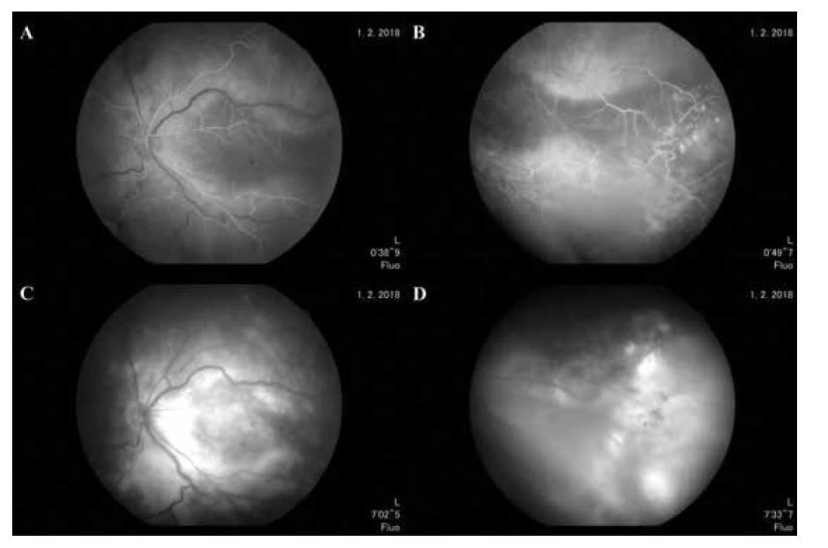 FAG vyšetrenie ĽO. (A) Skorá arteriovenózna fáza, vény sa začínajú laminárne plniť, (B) teleangiektatické
hyperfluorescencie v oblasti tumoru, (C) presakovanie fluoresceínu vo foveálnej avaskulárnej
zóne, (D) presakovaniu (leakage) a prifarbovaniu (staining) fluoresceínu v okolí tumoru