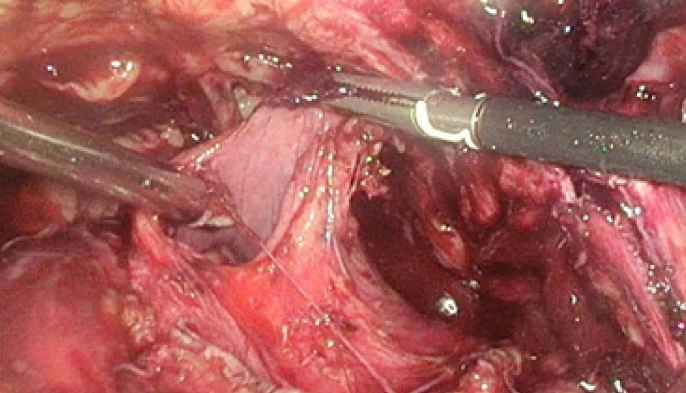 Laparoskopie – ruptura
pravé strany močového
měchýře<br>
Fig. 5. Laparoscopy – rupture
of the right side of the
urinary bladder