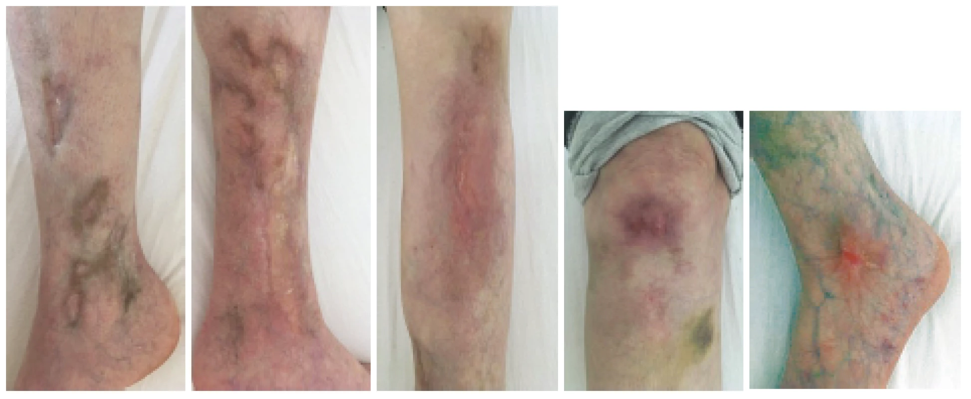 Definitivní zhojení kožní vaskulitidy v květnu 2019 při poslední hospitalizaci v RÚ. Celkem bylo podáno od 11/2017 deset pulzů
cyklofosfamidu v kumulativní dávce 4,1 g.