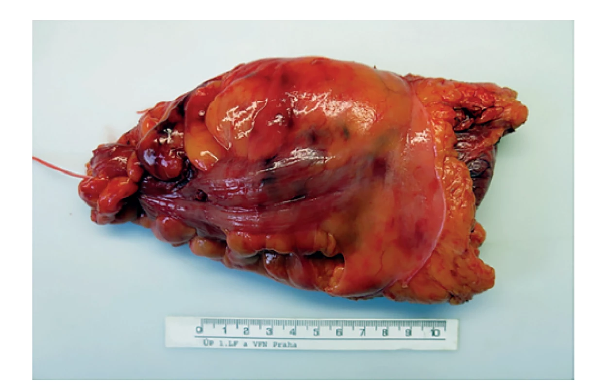 Fotodokumentace resekátu rekta pořízená patologem<br>
Fig. 2: Photodocumentation of the resected rectal specimen
by pathologist