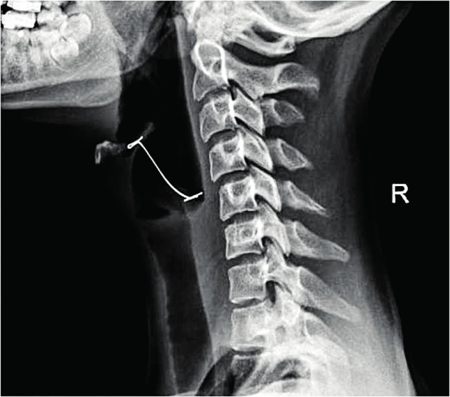  Část rovnátek ve vchodu do jícnu, boční snímek. <br><b>Fig. 10. </b>Part of dental braces in the entrance to the esophagus, side projection.