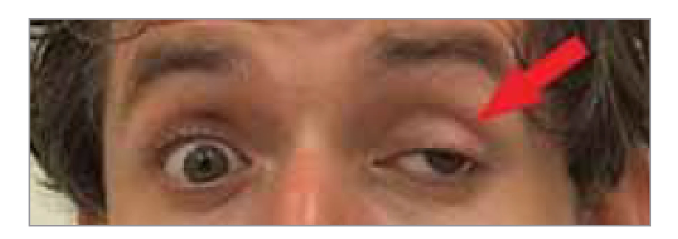 Ptóza horního víčka, mydriáza,
levé oko v abdukčním postavení
(šipka).<br>
Fig. 1. Ptosis of the upper eyelid, mydriasis,
left eye in the abduction position
(arrow).