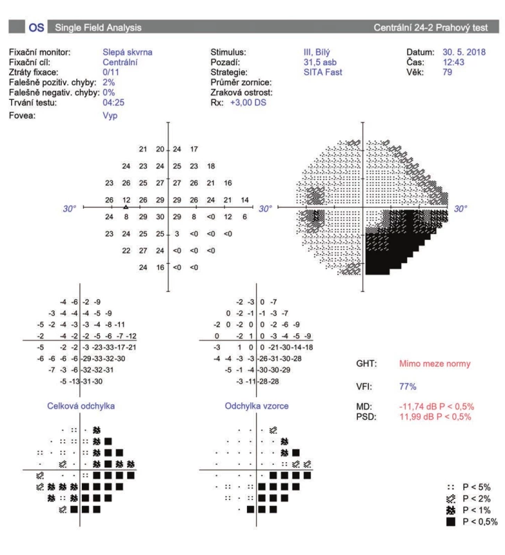 Perimeter of patient with progression of glaucoma pathology after cyclophotocoagulation (A, B)