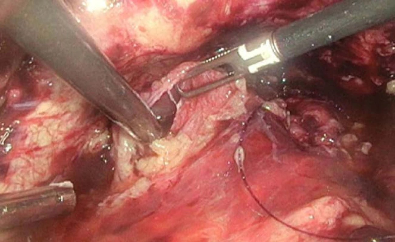 Laparoskopie – na
levé straně další ruptura močového
měchýře<br>
Fig. 6. Laparoscopy – On
left side of the urinary bladder,
the next rupture.