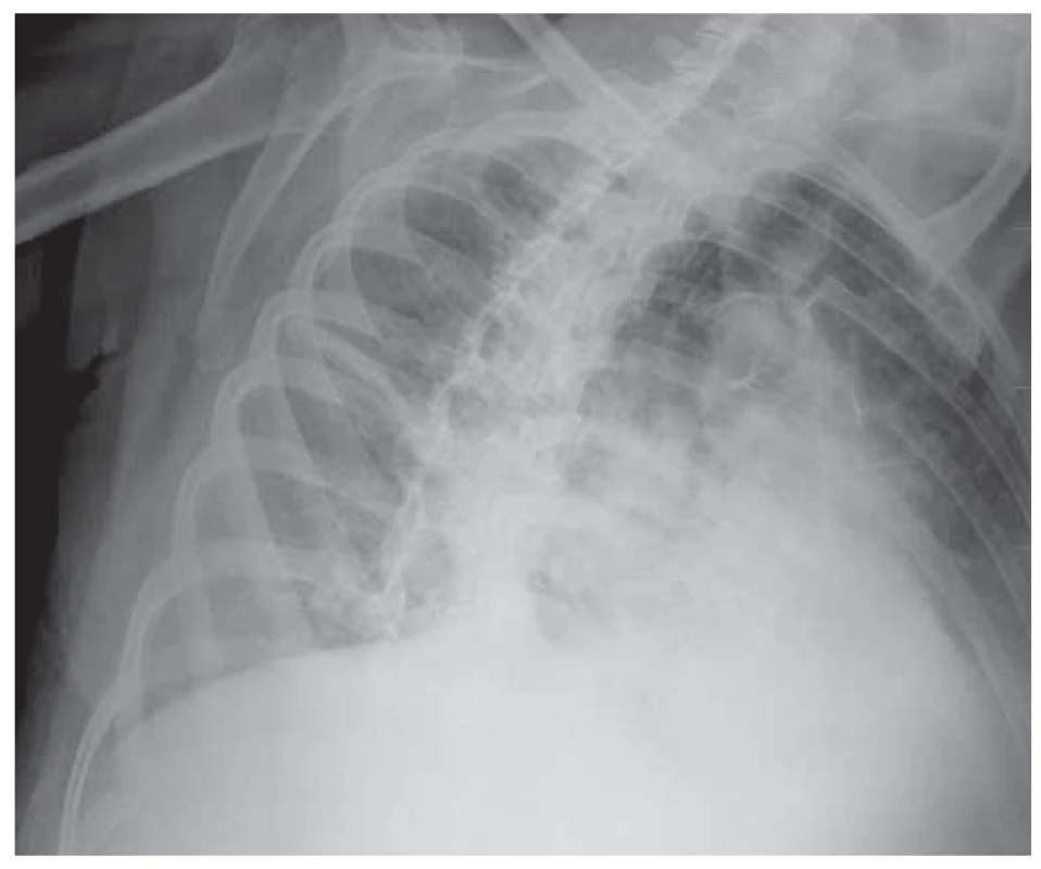 RTG hrudníka – pruhovité zatienenie perihilózne
vpravo s tekutinou v interlóbiu – zápalová infi ltrácia.<br>
Fig. 1. Chest X-ray – stripe shading perihilously on the right
with fl uid in the interlobium – infl ammatory infi ltration.