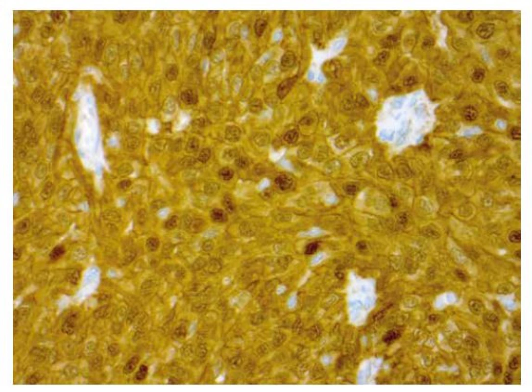 Imunohistochemický průkaz nukleární a cytoplazmatické pozitivity
beta kateinu v nádorové afekci (zvětšení 400x).
