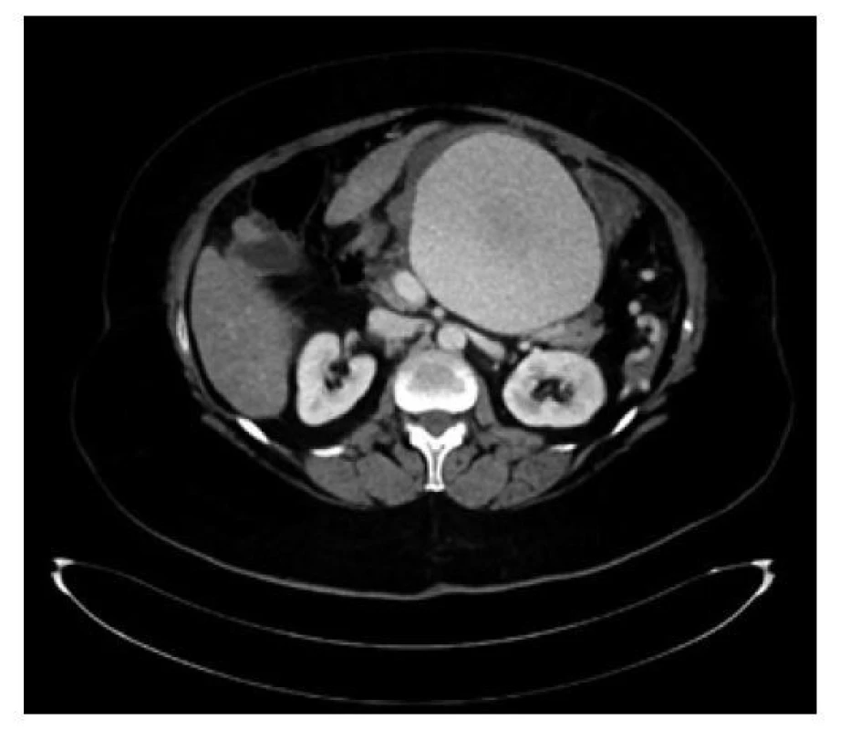 CT zobrazení výdutě v transverzální rovině<br>
Fig. 1: CT scan in the transverse plane showing the aneurysm