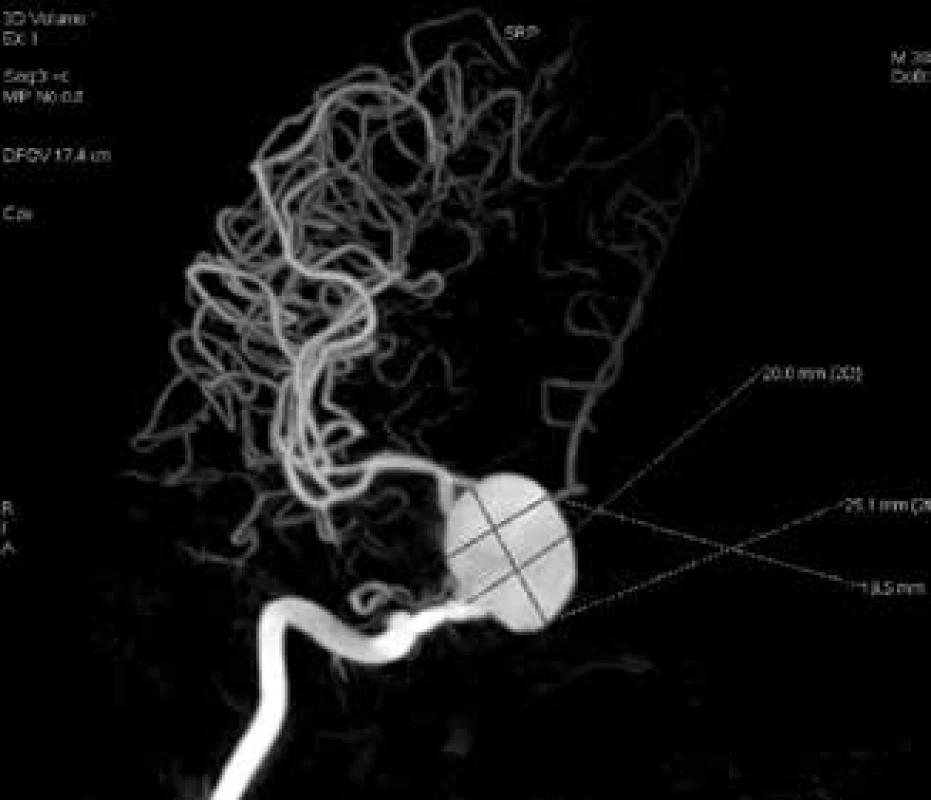 Dimensions of aneurysm