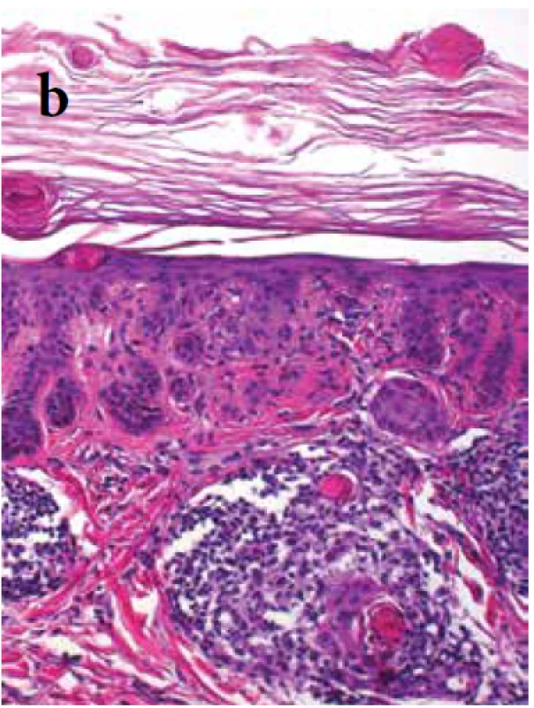  a, b. Epidermis s prstovitě vybíhajícími anastomózujícími
hyperpigmentovanými čepy, místy obsahujícími rohové
okrouhlé útvary přítomné ojediněle jak v rozšířené ortokeratotické
rohové vrstvě, tak v infiltrátu v horním koriu
