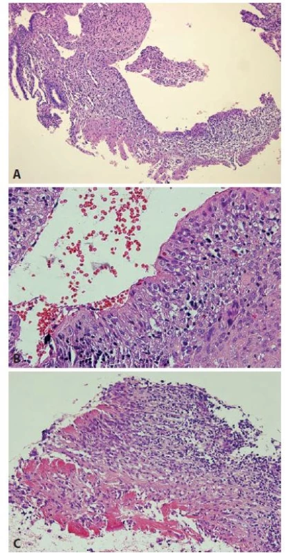 Synovial-like metaplasia of the endometrium, histological features.
A. At low power, polypoid fragment with surface synovial-like layer of the cells
is seen (case 1). B. Synovial-like cells are arranged perpendicular to the endometrial
cavity (case 1). C. Inflammatory infiltrates in the stroma and fibrin on
the surface (case 2) (original magnifications 100x, 400x and 200x, respectively).