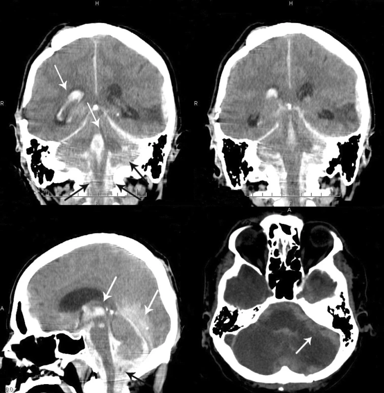A – CT scan (coronal section), intraventricular hemorrhage in the right
lateral ventricle and fourth ventricle, subdural collection overlying the left occipital
lobe, bilateral subdural hematoma in the posterior fossa and in the cervical
spinal canal. B – massive subdural collection surrounding the medulla and in
the cervical spinal canal. C – CT scan (sagittal section), massive supratentiorial
hemorrhage overlying the occipital lobes, third and fourth ventricular bleeding,
subdural hematoma surrounding the medulla and pons and in the cervical region
of the spinal cord. D – CT scan (transverse section), severe diffuse cerebellar
edema and bilateral subdural and subarachnoid hematoma.