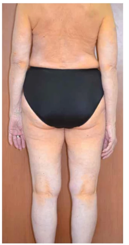 Xanthoma diffusum planum et intertriginosum
u nemocné s monoklonální gamapatií IgG kappa a asymptomatickým
mnohočetným myelomem IgG bez orgánového
postižení