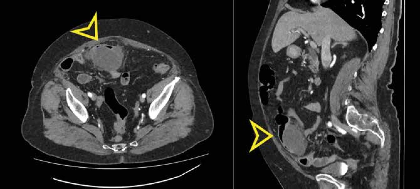 CT břicha v arteriální fázi v transverzální a sagitální rovině, šipkou označen absces těsně při utlačené kličce tenkého střeva<br>
Fig. 1: Arterial phase abdominal CT scan images in the transverse and sagittal planes; markers pointing to the abscess
cavity with an overlying small bowel loop