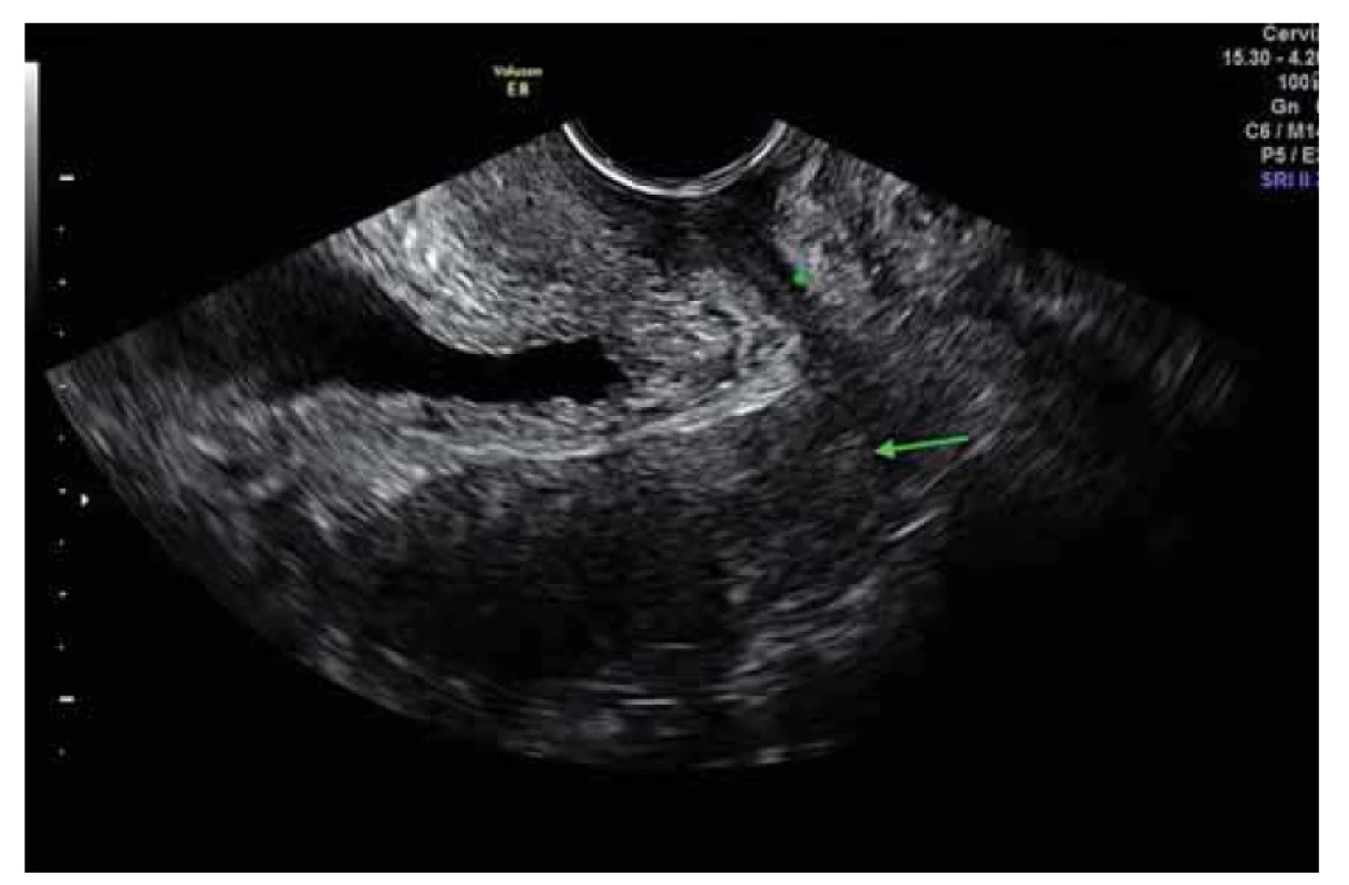 Ultrazvukový nález – 4. měsíc užívaní antituberkulotik, hvězdička –
synechie pochvy, šipka – cervix.<br>
Fig. 5. Ultrasound finding – 4th month of antituberculosis treatment, star – vaginal
synechiae, arrow – cervix uteri.