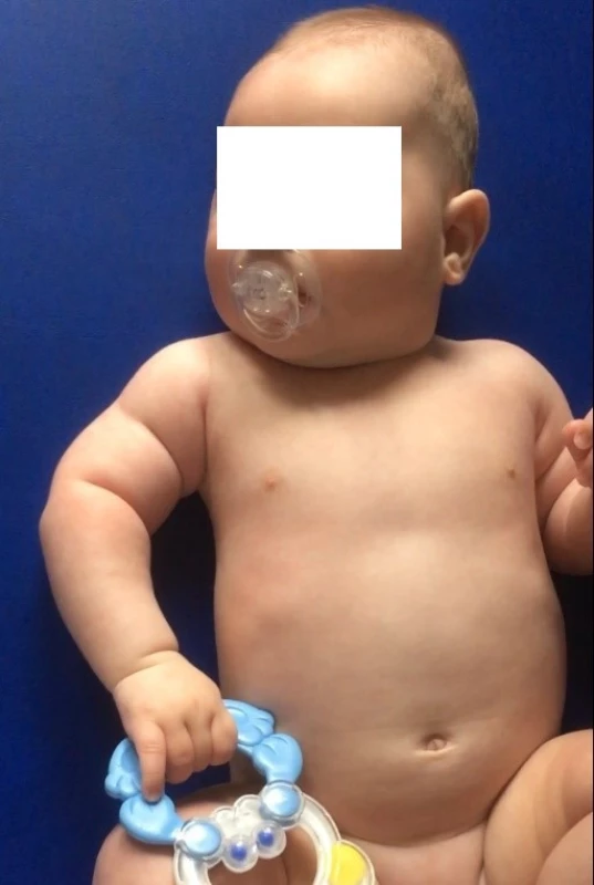  Věk 4 měsíce, na obrázku je patrná zejména hypotrofie musculus deltoideus a pažních svalů. <br>
Fig. 2. Age 4 months, the picture is particularly evident hypotrophy the deltoid muscle and upper arms muscles.