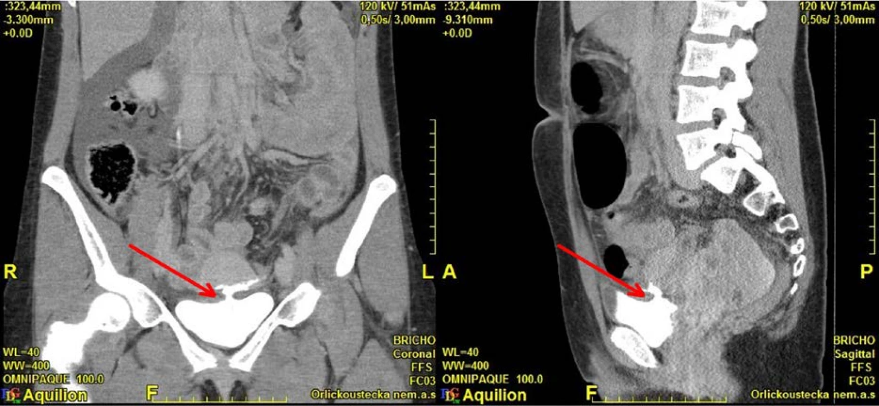 CT, koronární a sagitální řez: intraperitoneální perforace močového měchýře<br>
Fig. 5. CT, coronal and sagittal plane: intraperitoneal bladder perforation