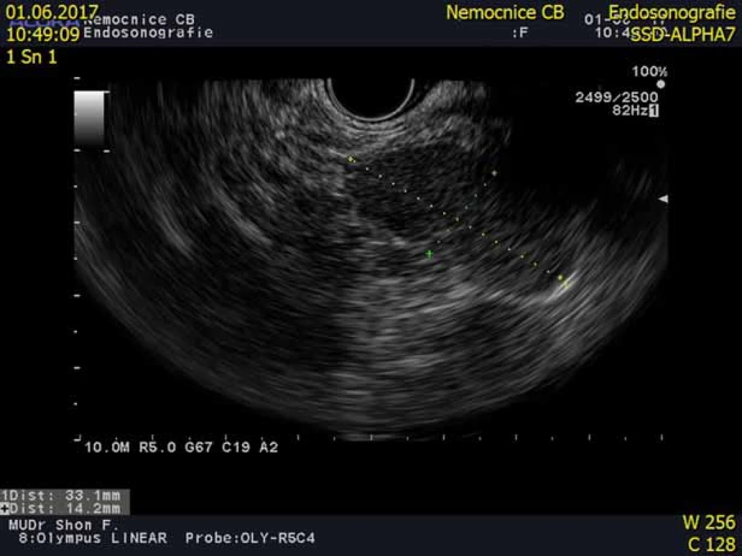 Endoskopická ultrasonografi e pankreatu s obrazem intrapankreaticky
uložené akcesorní sleziny (IPAS).
Fig. 5. An endoscopic ultrasound scan showing an intrapancreatic accessory
spleen (IPAS).
