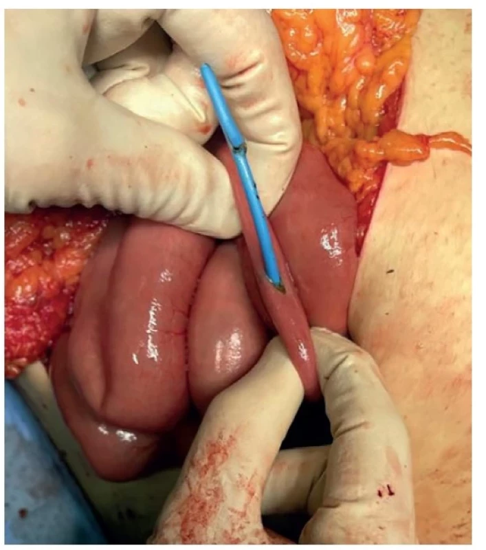 Dislokovaný drén vyhledán a odstraněn peroperačně
z enterotomie<br>
Fig.5: Localization and removal of the dislocated drain by
enterotomy