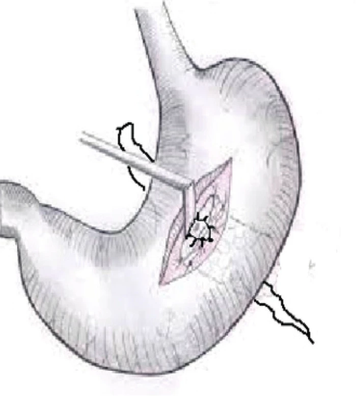 Gastrofistuloanastomóza<br>
Fig. 3. Gastrofistuloanastomosis