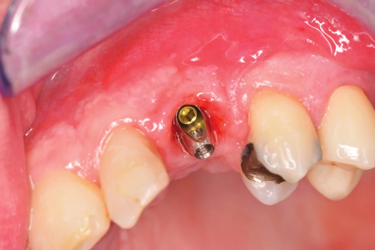 Abutment pro tranzverzální
šroubování in situ, okluzní
pohled; nevýhodná osa
manipulačního kanálu je
převedena na orální stranu
suprastruktry<br>
Fig. 3
The abutment for transversaly
screw-retained crown, oclusal
view; the screw acces hole is on
the oral surface of the crown