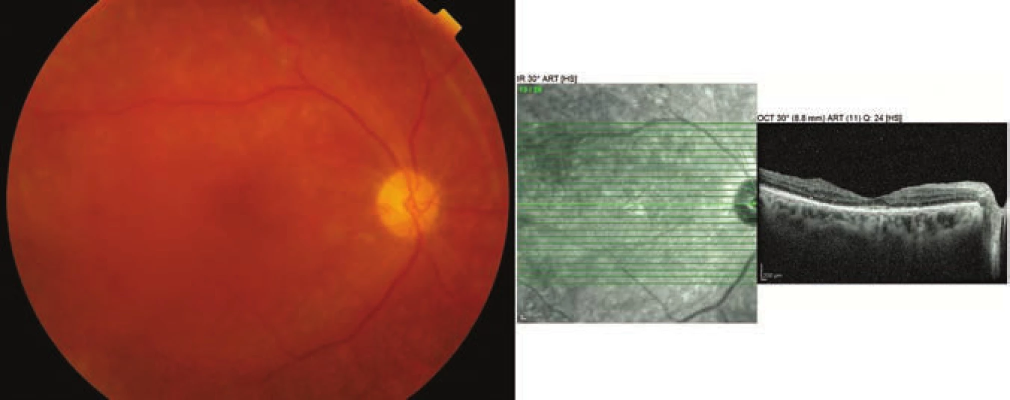 Photograph of ocular fundus and OCT examination of right eye 11 months after surgery
