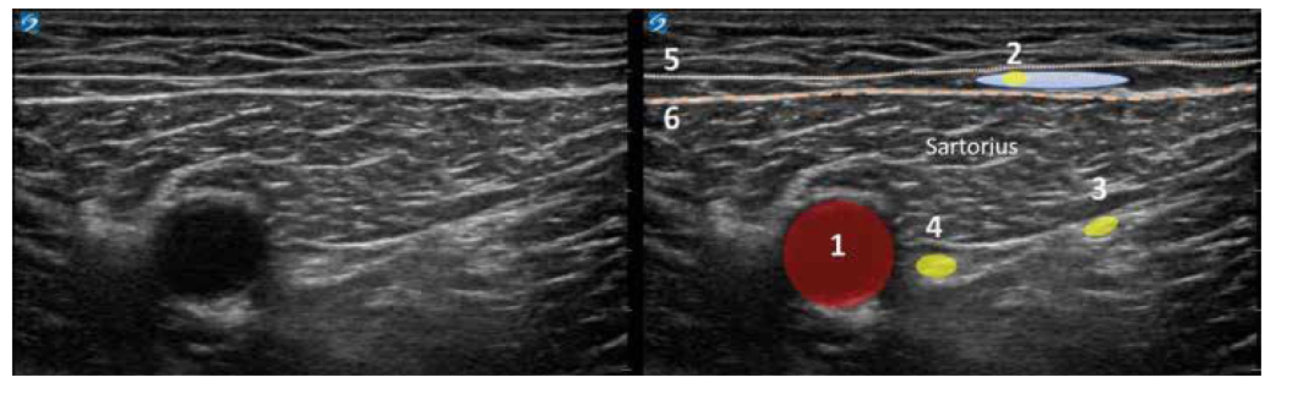 Nativní a kolorovaný ultrazvukový obraz v trigonum femorale. 1. arterie femoralis, 2. NCFIM, modrou barvou naznačeno lokální anestetikum,
3. n. vastus medialis, 4. nervus femoralis, 5. povrchní fascie stehna, 6. fascia lata