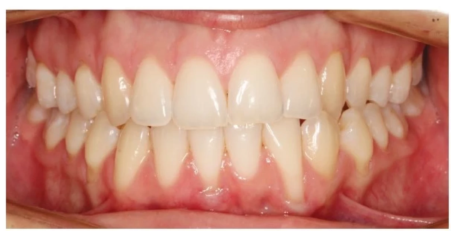 Gingivální recesy u zubů 14,
34, 32, 44 a 45.<br>
Fig. 1
Gingival recession on teeth
14, 34, 32, 44, and 45.