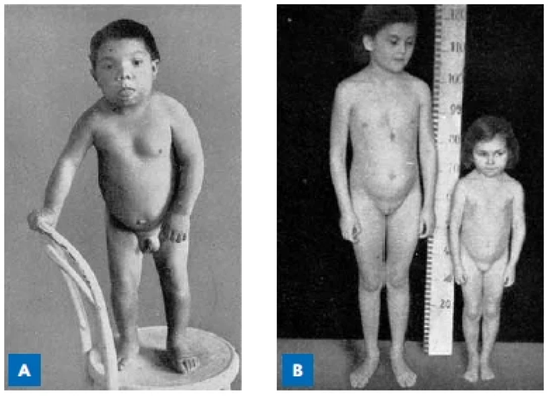 Výběr z rozsáhlé obrazové přílohy monografie prof. Čížkové-
-Písařovicové Klinická endokrinologie dětského věku (1954).
(A) „Pacient J. K. kong. hypothyreoidismus 15 r. starý“; (B) „Pacientka
V. J. hypofysární nanismus 10 r. st. ve srovnání se stejně starou
dívkou“.