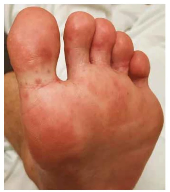 Ukázka exantému na ploskách.<br>
Fig. 2. Example of exanthema on the bottoms of the feet.
