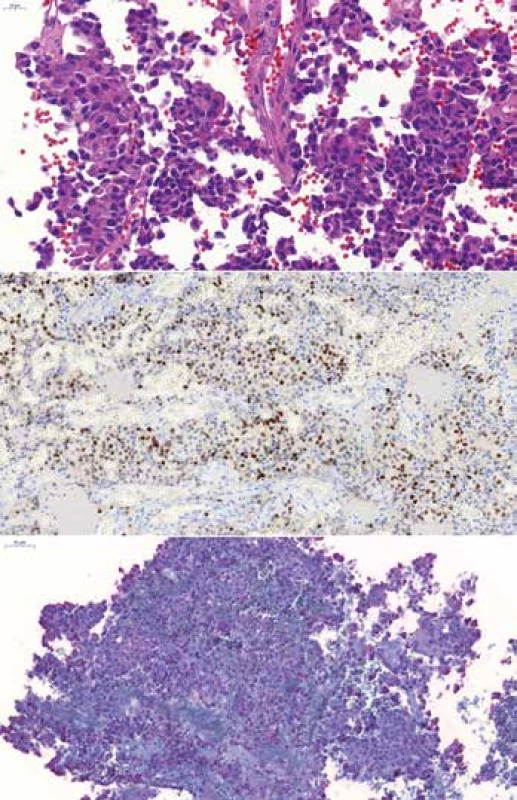 <b>(A)</b> „Sparsely granulated“ kortikotropný adenóm u 46-ročného
muža, HE 400x. <b>(B)</b> Expresia transkripčného faktora T-Pit, 200x. <b>(C)</b> Fokálna
variabilne intenzívna expresia ACTH, 200x